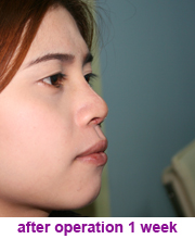 plastic_surgery_augmentation_rhinoplasty